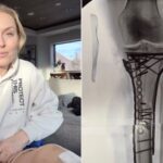 Възстановяването на Линдзи Вон ще отнеме година, но няма да ампутират крака ѝ