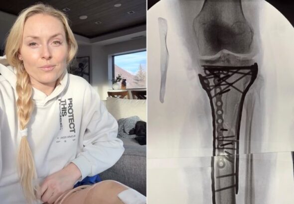 Възстановяването на Линдзи Вон ще отнеме година, но няма да ампутират крака ѝ